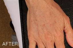 Miotto Plastic Surgery (Dr. Gabriele Miotto) fat transfer result