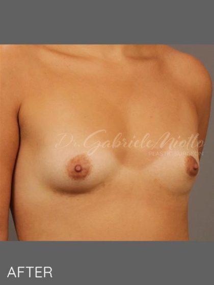 Miotto Plastic Surgery (Dr. Gabriele Miotto) breast augmentation after — Atlanta, GA