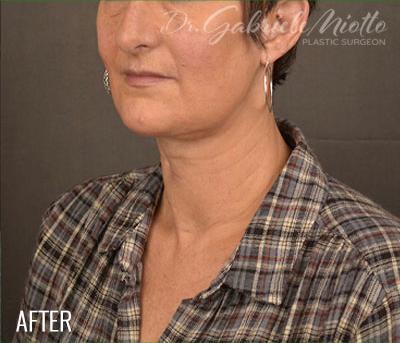 Facelift after at Miotto Plastic Surgery (Dr. Gabriele Miotto) in Atlanta, GA