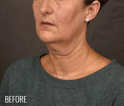 Facelift before at Miotto Plastic Surgery (Dr. Gabriele Miotto) in Atlanta, GA
