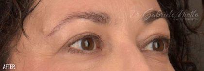 Miotto Plastic Surgery (Dr. Gabriele Miotto) blepharoplasty after — Atlanta, GA