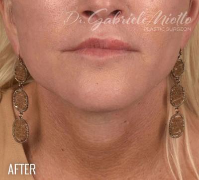 Neck Lift after at Miotto Plastic Surgery (Dr. Gabriele Miotto) in Atlanta, GA