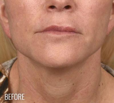 Neck Lift before at Miotto Plastic Surgery (Dr. Gabriele Miotto) in Atlanta, GA
