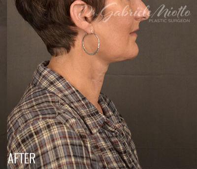 Facelift after at Miotto Plastic Surgery (Dr. Gabriele Miotto) in Atlanta, GA