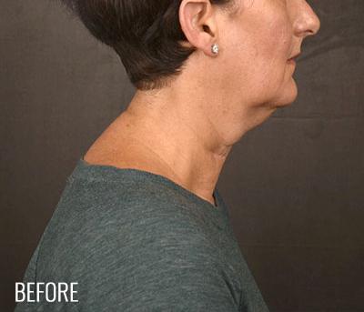 Facelift before at Miotto Plastic Surgery (Dr. Gabriele Miotto) in Atlanta, GA