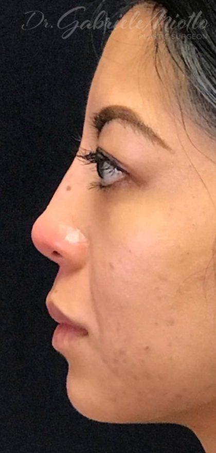 Miotto Plastic Surgery (Dr. Gabriele Miotto) rhinoplasty after — Atlanta, GA