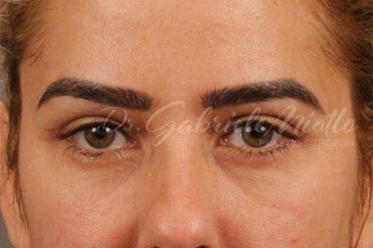 Miotto Plastic Surgery (Dr. Gabriele Miotto) blepharoplasty after — Atlanta, GA