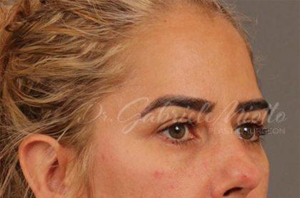Miotto Plastic Surgery (Dr. Gabriele Miotto) blepharoplasty after — Atlanta, GA