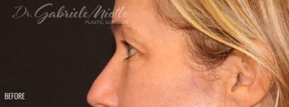 Brow Lift before at Miotto Plastic Surgery (Dr. Gabriele Miotto) in Atlanta, GA