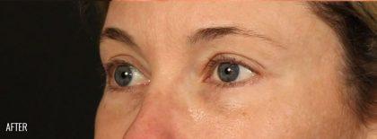 Brow Lift after at Miotto Plastic Surgery (Dr. Gabriele Miotto) in Atlanta, GA