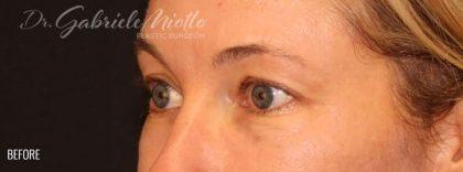 Brow Lift before at Miotto Plastic Surgery (Dr. Gabriele Miotto) in Atlanta, GA