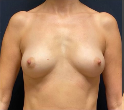 Breast Augmentation before at Miotto Plastic Surgery (Dr. Gabriele Miotto) in Atlanta, GA