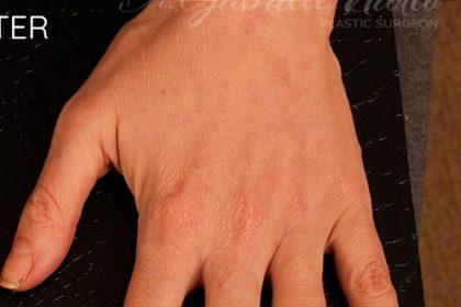 Miotto Plastic Surgery (Dr. Gabriele Miotto) fat transfer after — Atlanta, GA