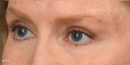 Miotto Plastic Surgery (Dr. Gabriele Miotto) blepharoplasty after — Atlanta, GA