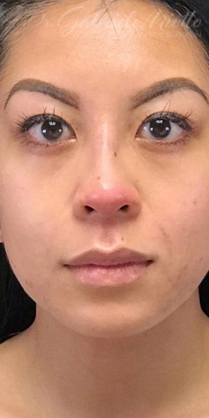 Miotto Plastic Surgery (Dr. Gabriele Miotto) rhinoplasty after — Atlanta, GA
