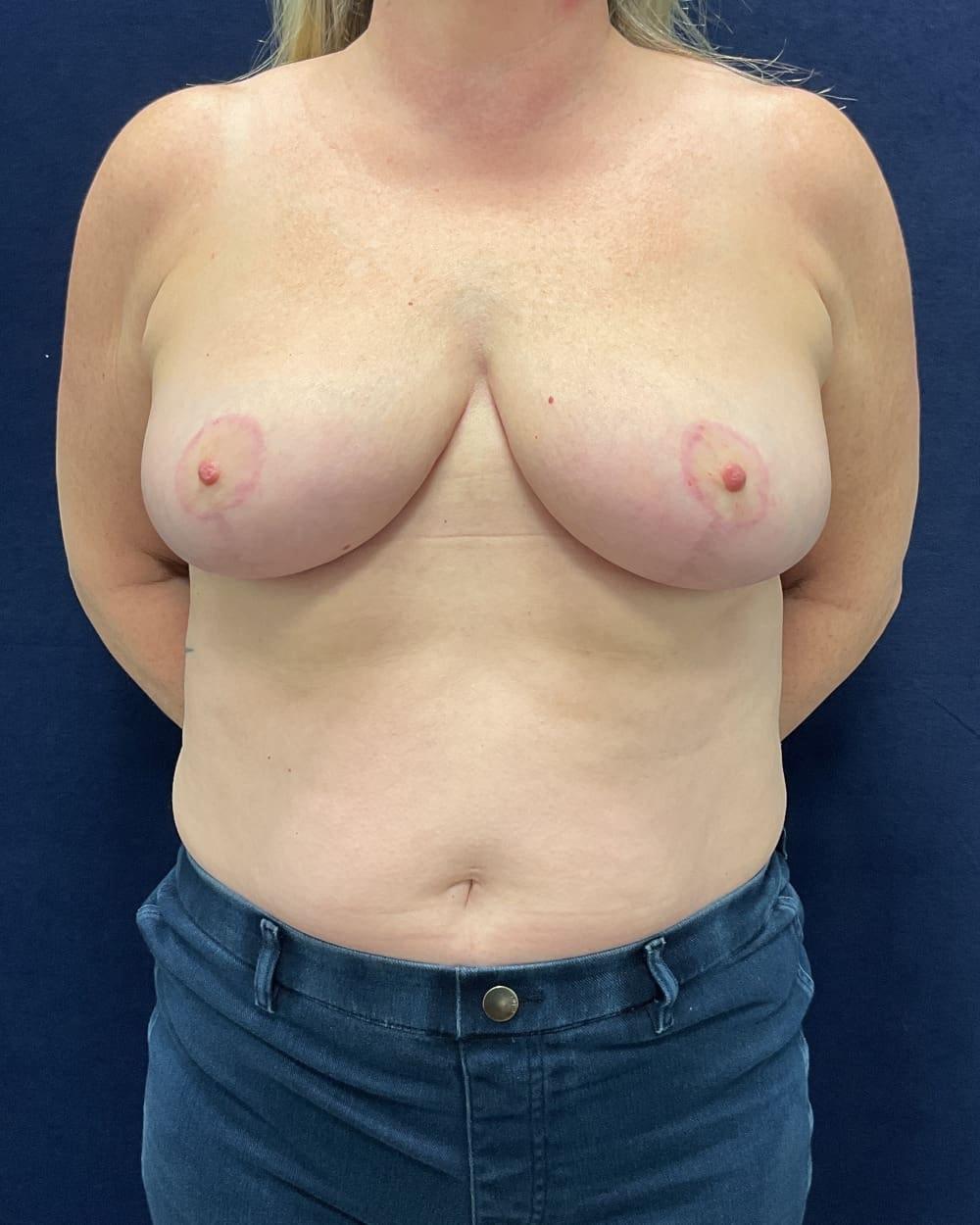 Columbia Aesthetic Plastic Surgery breast reduction after — Columbia, MD