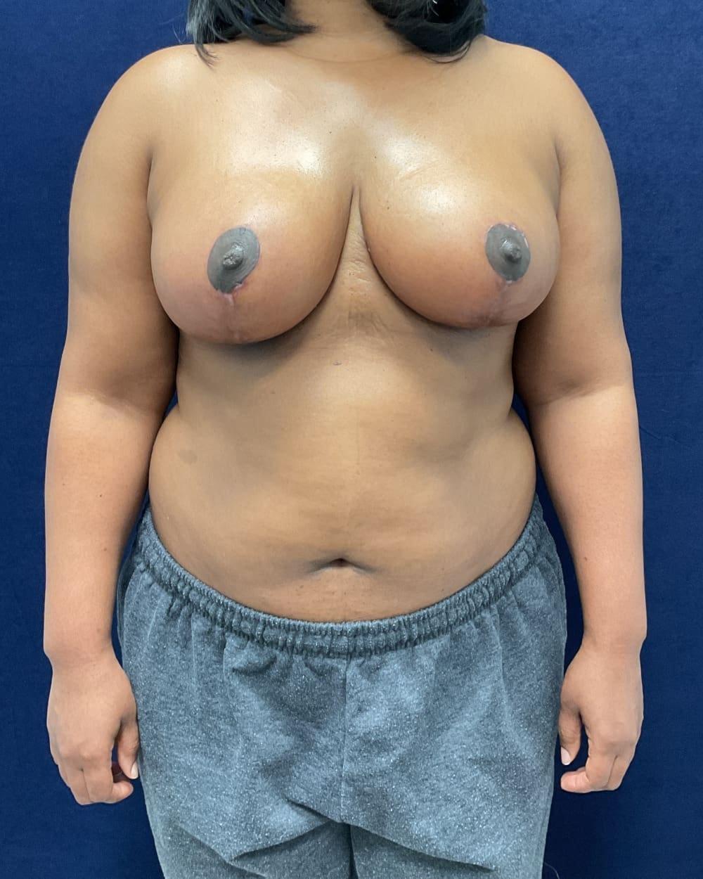 Columbia Aesthetic Plastic Surgery breast reduction after — Columbia, MD