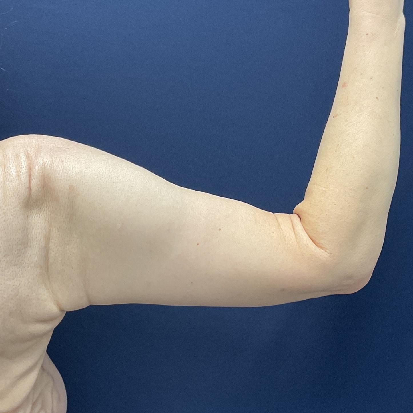 Columbia Aesthetic Plastic Surgery arm lift after — Columbia, MD