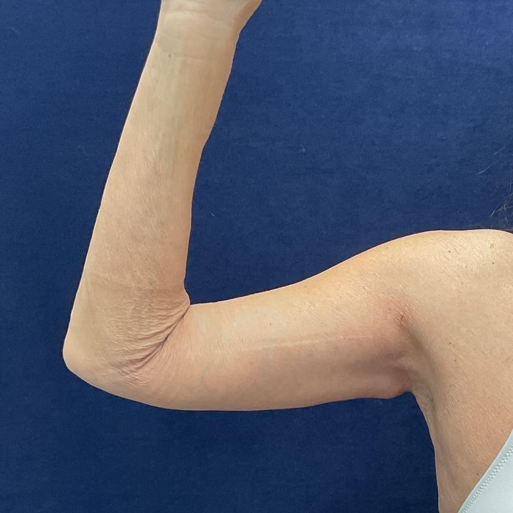Columbia Aesthetic Plastic Surgery arm lift after — Columbia, MD