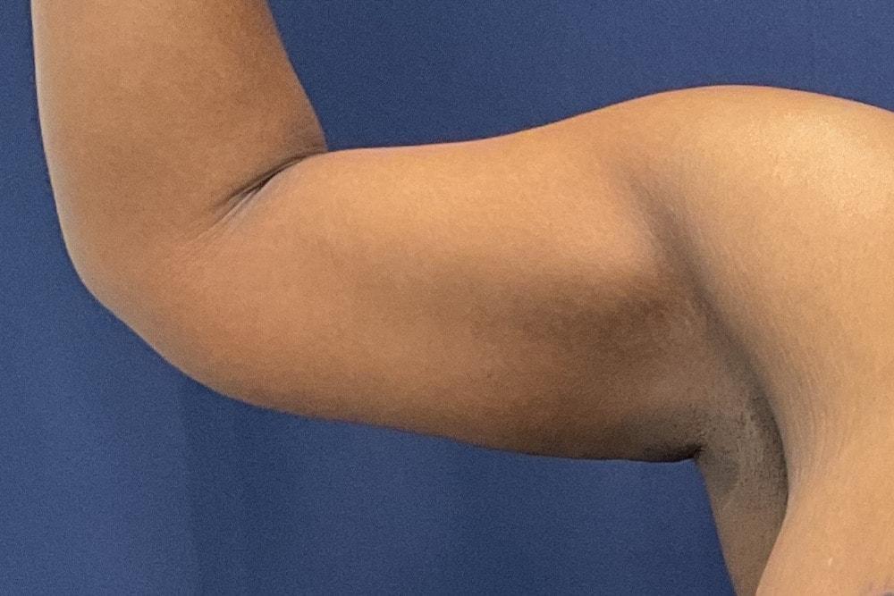 Columbia Aesthetic Plastic Surgery arm lift after — Columbia, MD