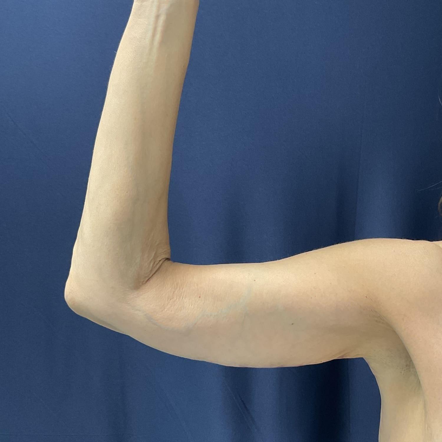 Columbia Aesthetic Plastic Surgery arm lift after — Columbia, MD