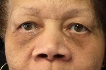 Chrysalis Cosmetics (Charles Perry, MD) eyelid lift after — Sacramento, CA