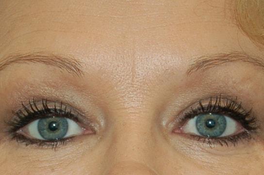 Chrysalis Cosmetics (Charles Perry, MD) eyelid lift after — Sacramento, CA