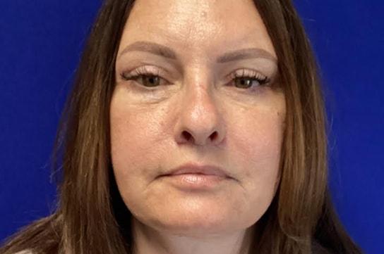 Chrysalis Cosmetics (Charles Perry, MD) facelift after — Sacramento, CA
