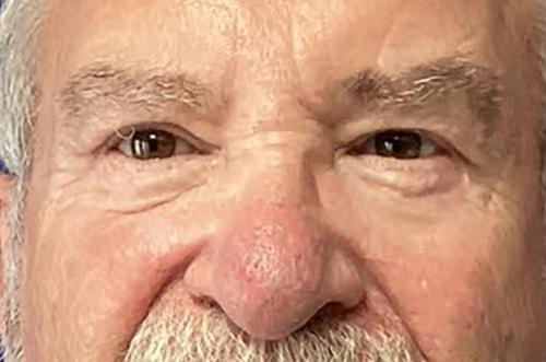 Chrysalis Cosmetics (Charles Perry, MD) eyelid lift after — Sacramento, CA