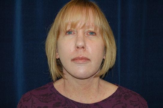 Chrysalis Cosmetics (Charles Perry, MD) facelift after — Sacramento, CA