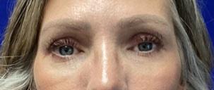 Chrysalis Cosmetics (Charles Perry, MD) eyelid lift after — Sacramento, CA