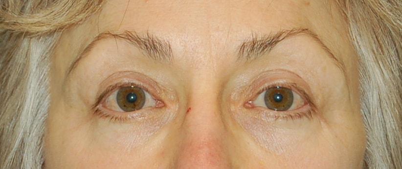 Chrysalis Cosmetics (Charles Perry, MD) eyelid lift after — Sacramento, CA