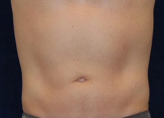 Chrysalis Cosmetics (Charles Perry, MD) liposuction after — Sacramento, CA