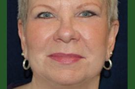 Chrysalis Cosmetics (Charles Perry, MD) facelift after — Sacramento, CA