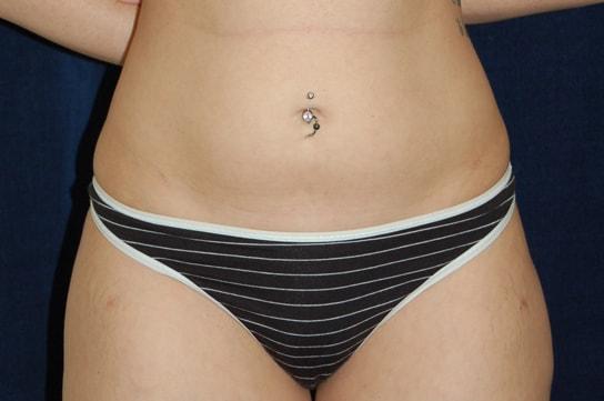 Chrysalis Cosmetics (Charles Perry, MD) liposuction after — Sacramento, CA