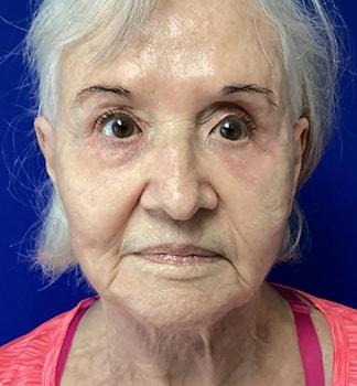 Chrysalis Cosmetics (Charles Perry, MD) facelift after — Sacramento, CA