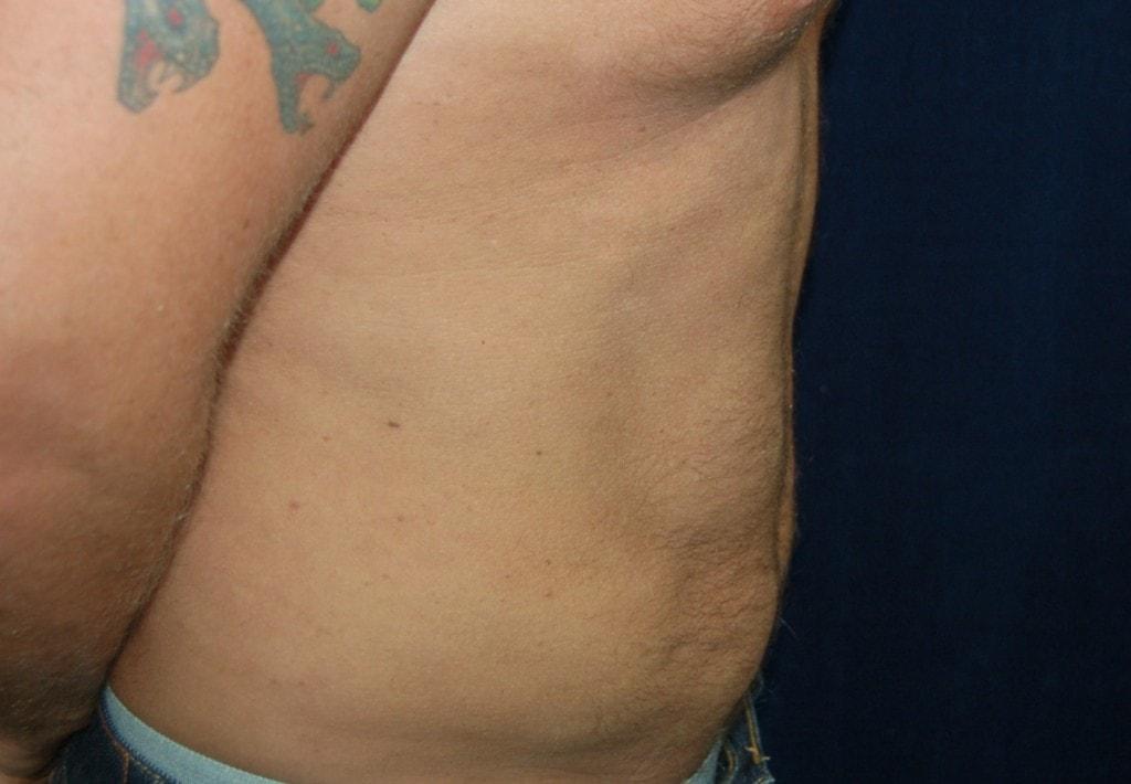Chrysalis Cosmetics (Charles Perry, MD) liposuction after — Sacramento, CA