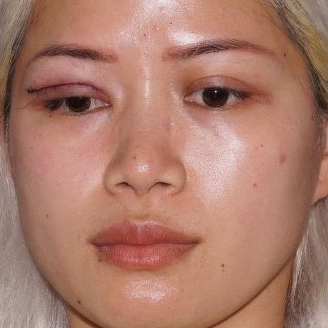 Blepharoplasty after at Dr. David Gerth Plastic Surgery in Coral Gables, FL