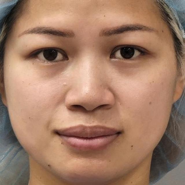 Blepharoplasty before at Dr. David Gerth Plastic Surgery in Coral Gables, FL