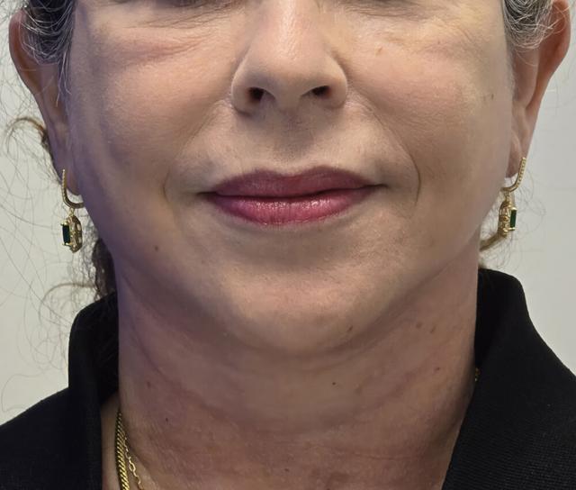 Facelift after at Dr. David Gerth Plastic Surgery in Coral Gables, FL