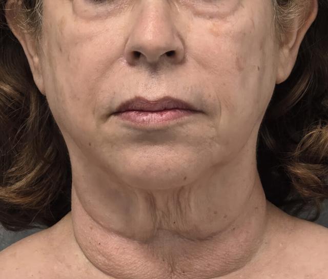 Facelift before at Dr. David Gerth Plastic Surgery in Coral Gables, FL