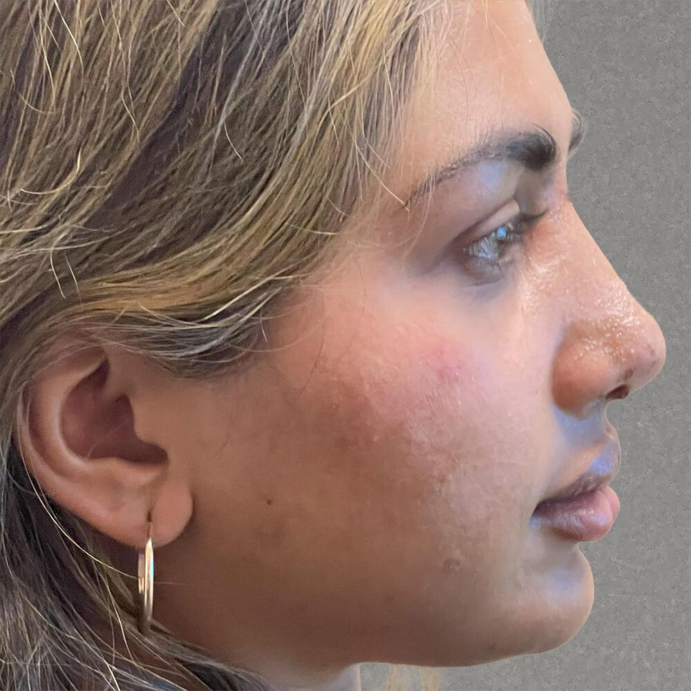 Dr. David Gerth Plastic Surgery rhinoplasty after — Coral Gables, FL