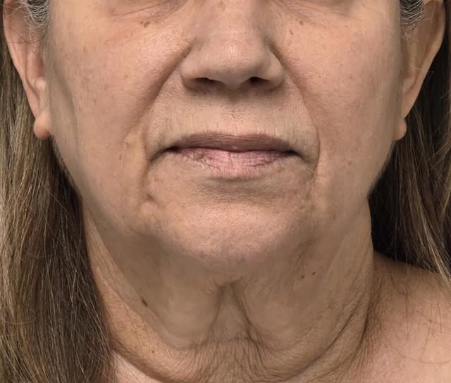 Facelift before at Dr. David Gerth Plastic Surgery in Coral Gables, FL