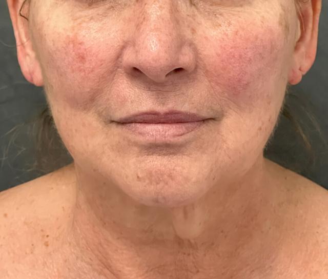Facelift before at Dr. David Gerth Plastic Surgery in Coral Gables, FL