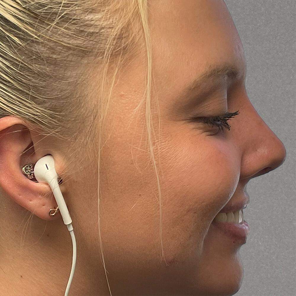 Dr. David Gerth Plastic Surgery rhinoplasty after — Coral Gables, FL