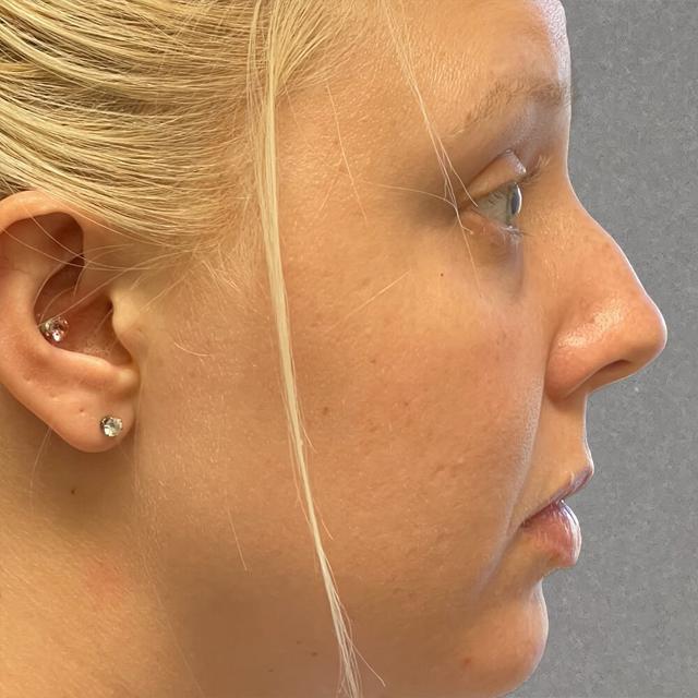 Rhinoplasty before at Dr. David Gerth Plastic Surgery in Coral Gables, FL