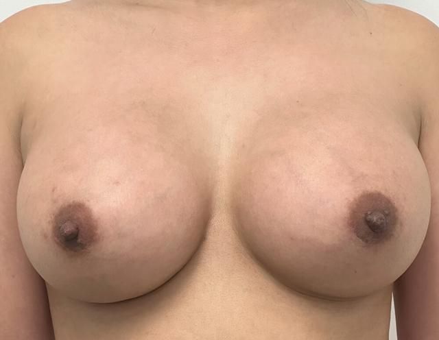 Breast Augmentation after at Dr. David Gerth Plastic Surgery in Coral Gables, FL