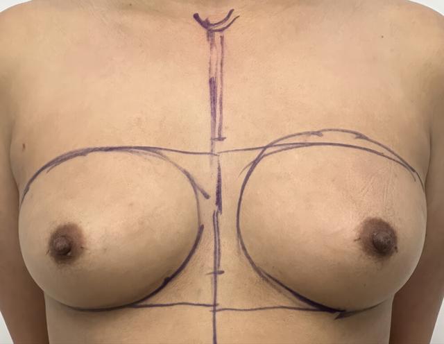 Breast Augmentation before at Dr. David Gerth Plastic Surgery in Coral Gables, FL