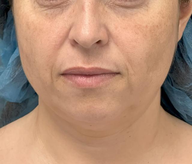 Facelift before at Dr. David Gerth Plastic Surgery in Coral Gables, FL