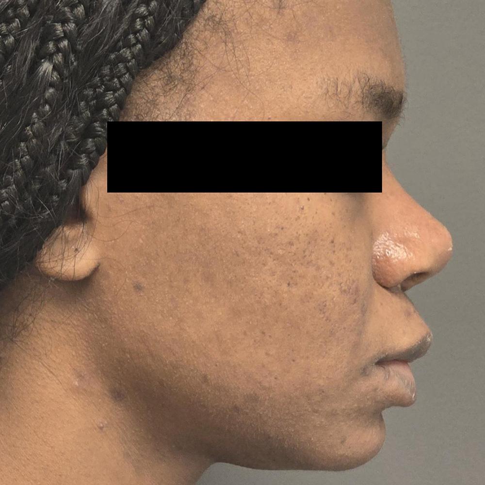 Dr. David Gerth Plastic Surgery rhinoplasty after — Coral Gables, FL